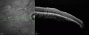 58223_Epiretinal_Membrane_OCT.