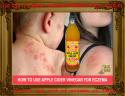 63886_how_to_get_rid_of_eczema_on_face.