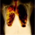 65970_asbestos-cancer-mesothelioma.